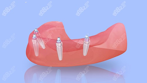 半口种植牙四颗植体植入漫画图