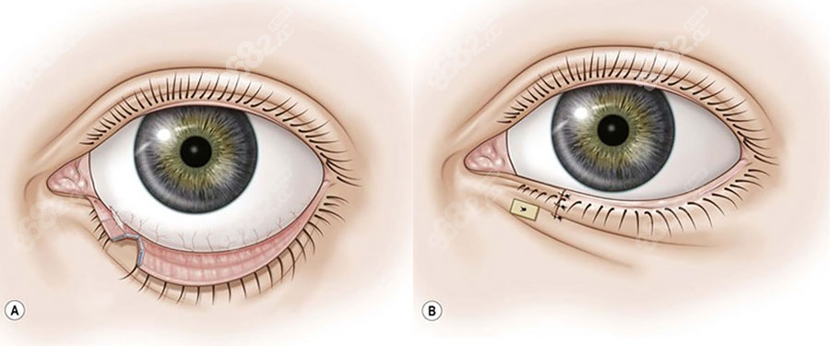 贺洁眼睑外翻多少钱？