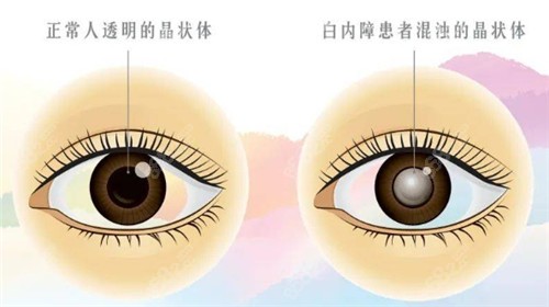 白内障晶状体照片
