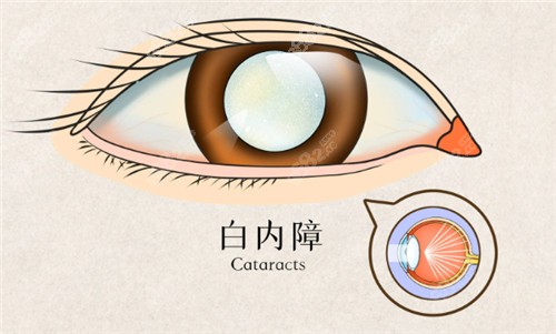 白内障卡通图
