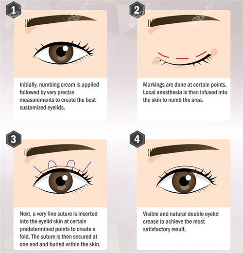 埋线双眼皮手术流程图.jpg