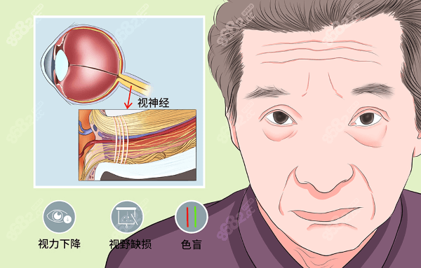 视神经萎缩症状