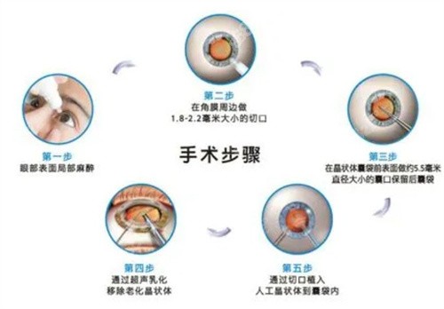 白内障手术步骤示意图