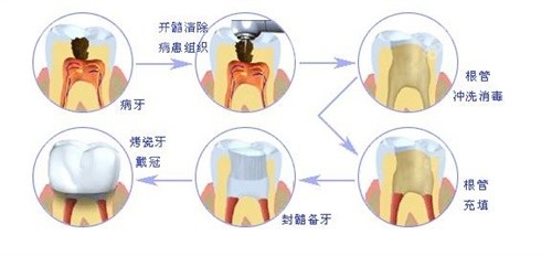 根管治疗图