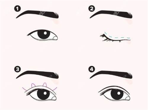 埋线双眼皮手术过程图.jpg