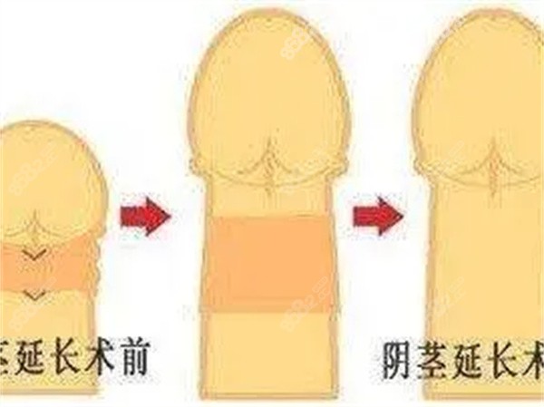 阴茎增粗 阴茎增粗
