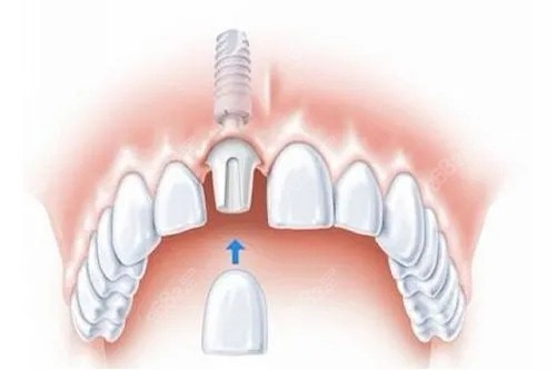 单颗种植牙安装牙冠卡通示意图