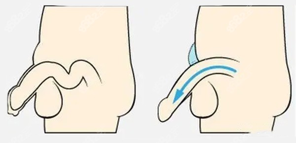 阴茎增粗 阴茎增粗