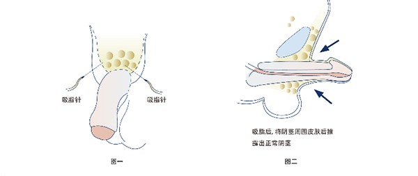 李世荣医生做男科手术怎么样