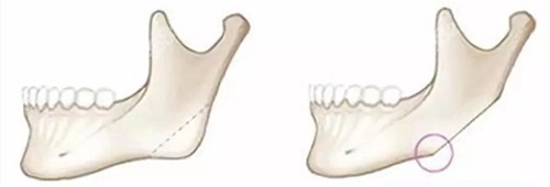 下颌骨切除前后动画演示图.jpg