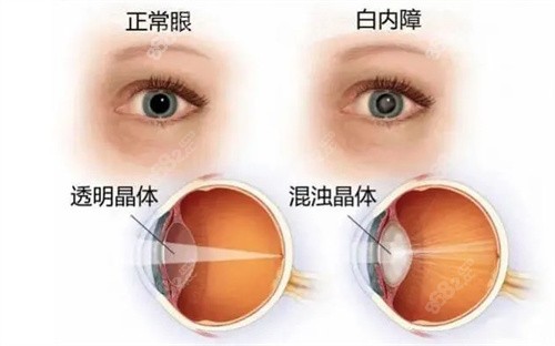 白内障眼球表现