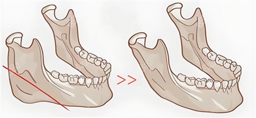下颌骨切除步骤动画演示图.jpg