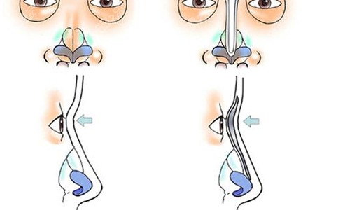 鼻小柱延長(zhǎng)的手術(shù)流程圖