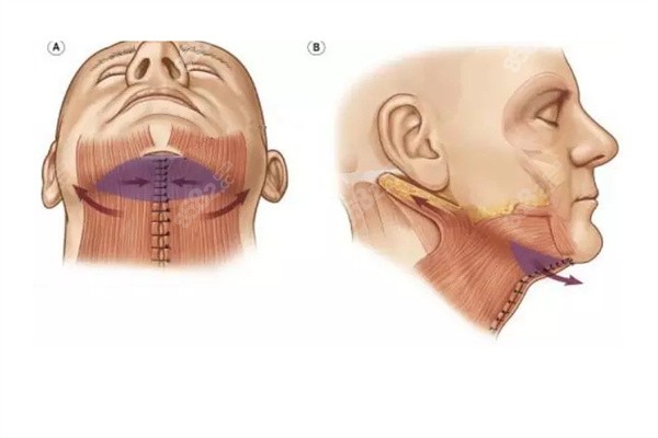 颈阔肌成型手术能维持多久