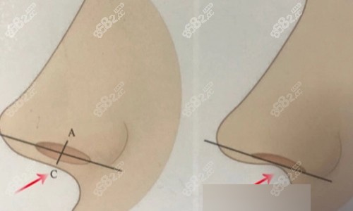 需要進(jìn)行鼻小柱延長(zhǎng)手術(shù)的情況