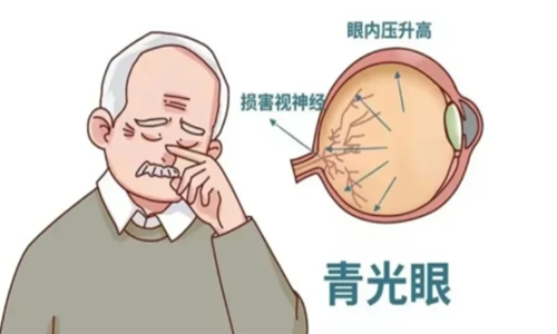 自查!青光眼的症状和表现是什么?青光眼该如何预防和治疗？