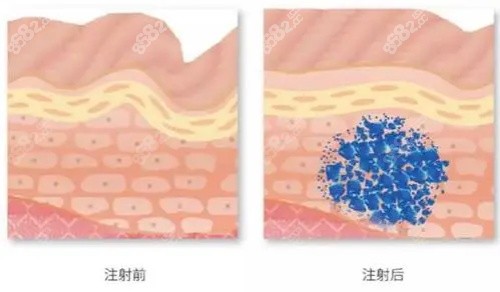 玻尿酸注射示意图