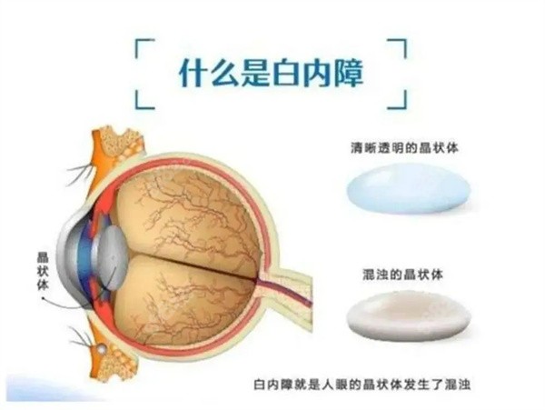 什么是白内障图解