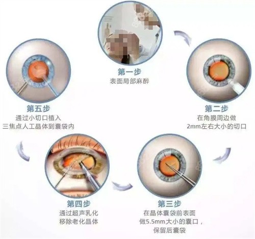 白内障超声乳化手术过程图