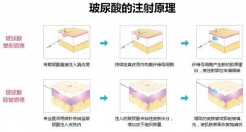 玻尿酸注射原理