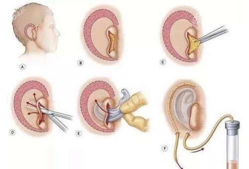 耳畸形矫正过程图