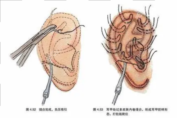 耳廓畸形是什么引起的