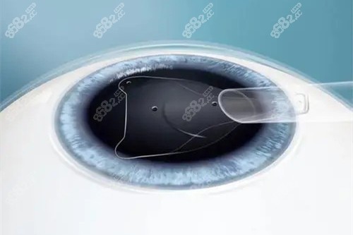 眼科员工的良心忠告：不是什么人都能做近视手术快来看！