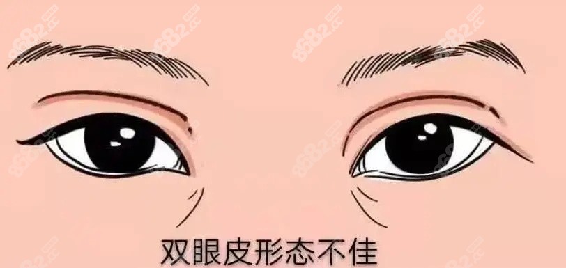 双眼皮不对称动画图