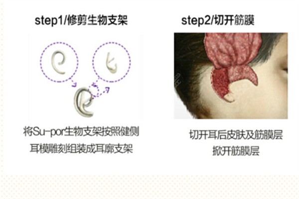 耳廓畸形矫正哪个医院好