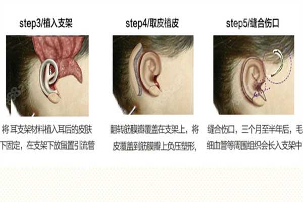 耳廓畸形矫正费用多少