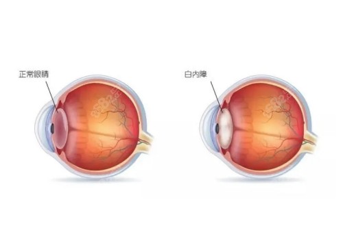 正常眼睛与白内障眼镜对比图.jpg