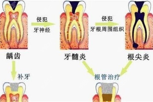 牙髓炎治疗过程图