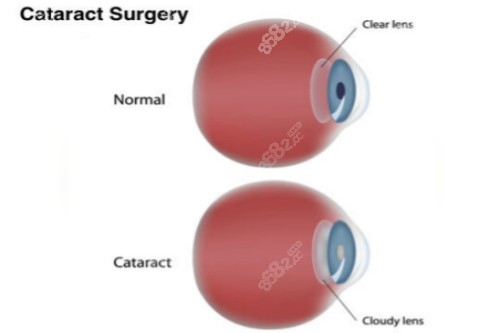 正常眼睛和白内障眼睛的照片