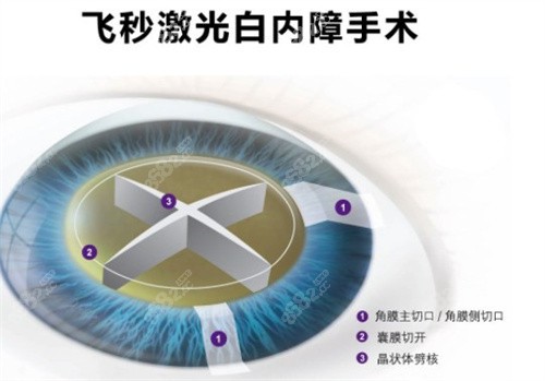 飞秒激光治疗白内障手术细节图