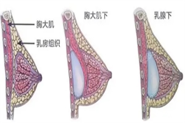 重庆陈德法隆胸怎么样