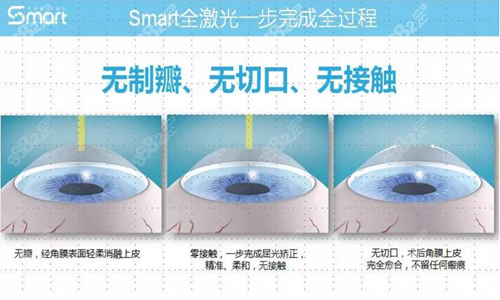 Smart全激光手术过程