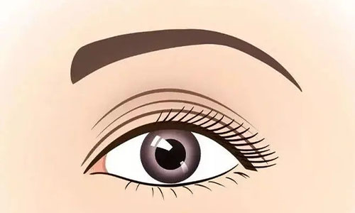 魏志香医生双眼皮修复实例展示，打造自然无痕魅力双眼