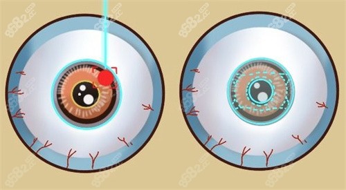 激光类近视手术和ICL晶体植入手术