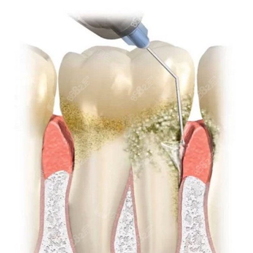 牙周刮治细节图