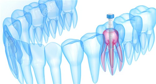 牙齿内部根管模拟图