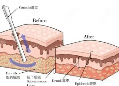 上海全身抽脂费用