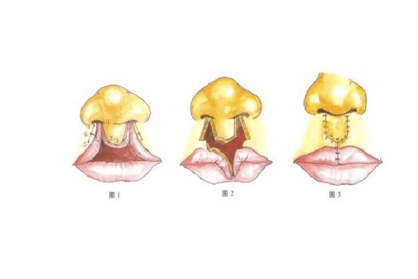上海唇腭裂整形价格