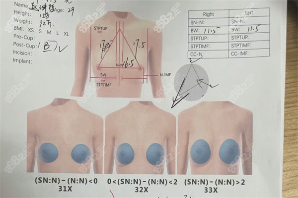 上海丰胸手术价格查询