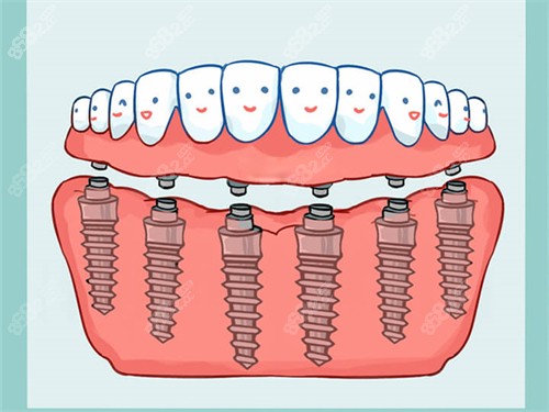 All-On-6全口种植牙漫画图
