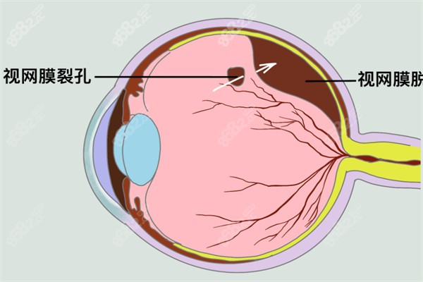 爱尔眼科做视网膜手术