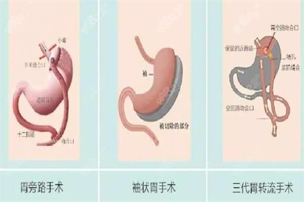 不同类型切胃手术