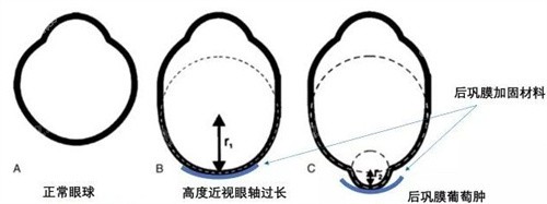 后巩膜加固术