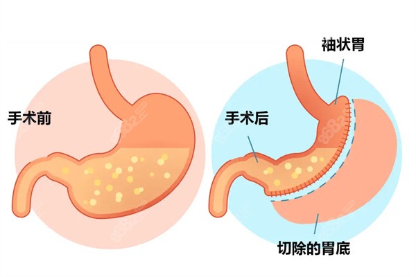 切胃手术怎么做