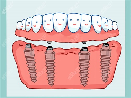 All-On-4全口种植牙漫画图.jpg
