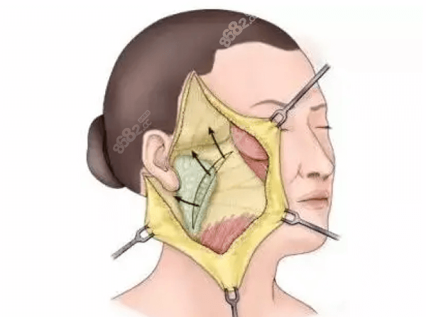 杜太超小切口拉皮手术采用微切口进行精密剥离